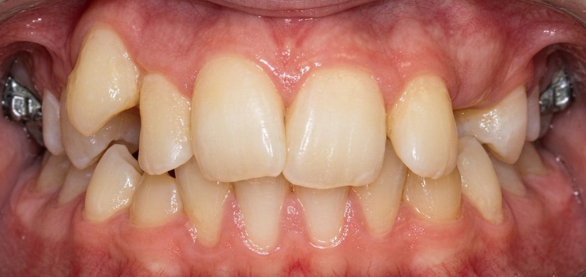 Vivid Smiles patient case 8 before and after treatment comparison before
